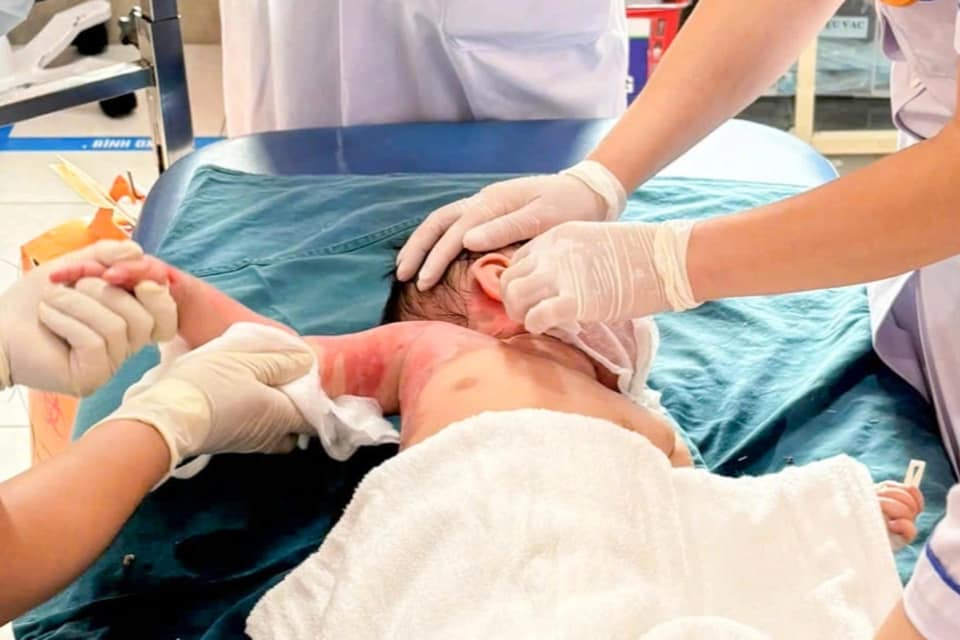 Hà Nội: 3 trẻ trong một gia đình bị bỏng do lật nồi lẩu